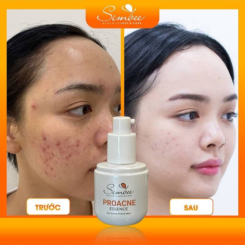 Serum trị mụn Simbee Proacne