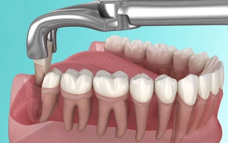 Chăm sóc răng miệng sau khi nhổ răng khôn