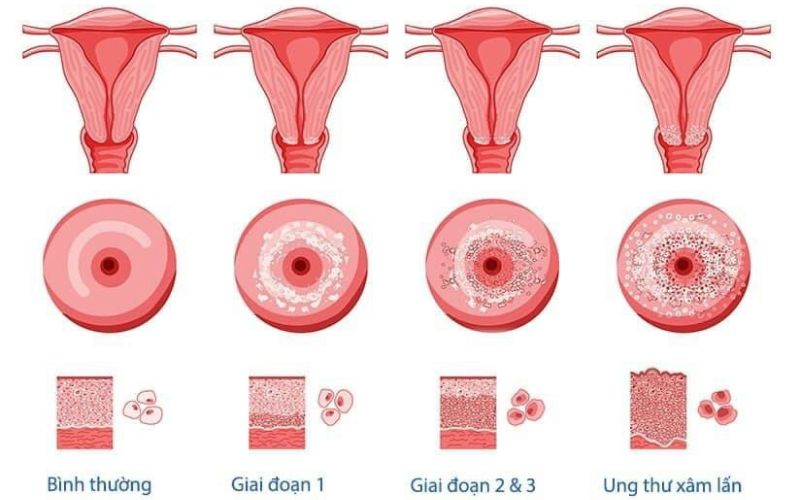 Ung thư cổ tử cung có chữa khỏi được không