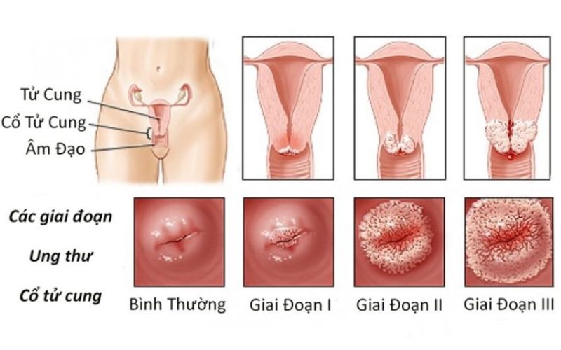 Ung thư cổ tử cung có chữa khỏi được không