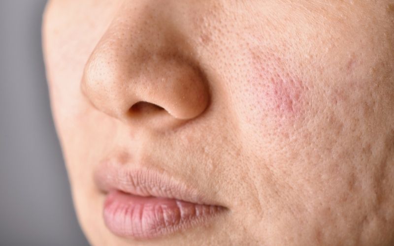 Bí quyết vàng trong làng skincare se khít lỗ chân lông