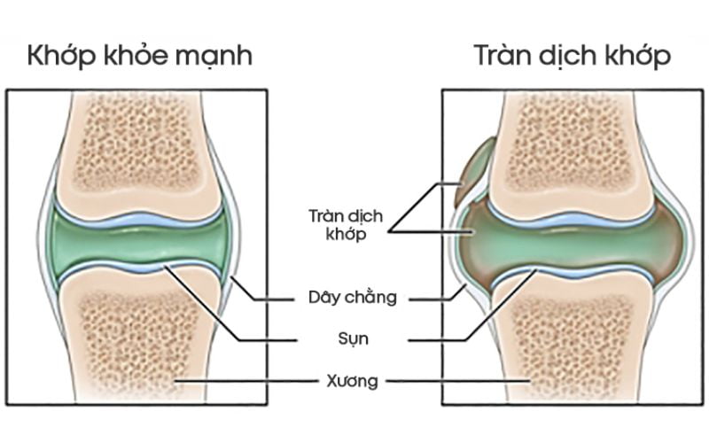 Tràn dịch khớp gối có nguy hiểm không?