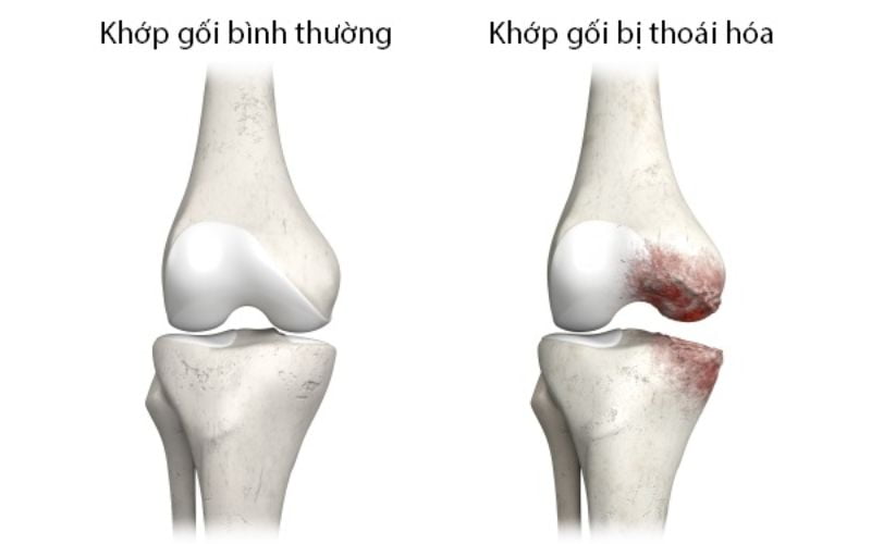 Tiến trình diễn tiến của bệnh xương khớp